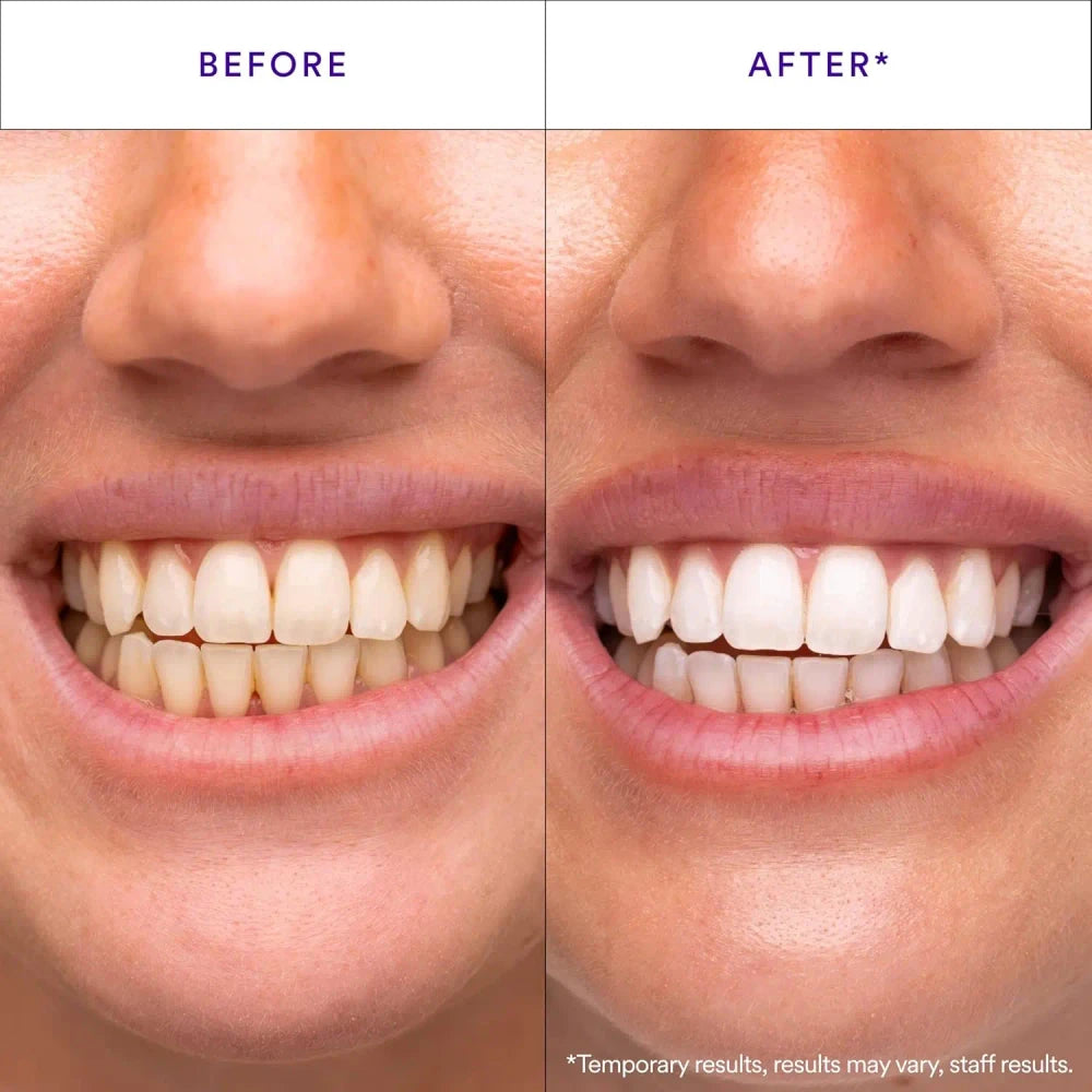 V34 Purple Whitening Strips